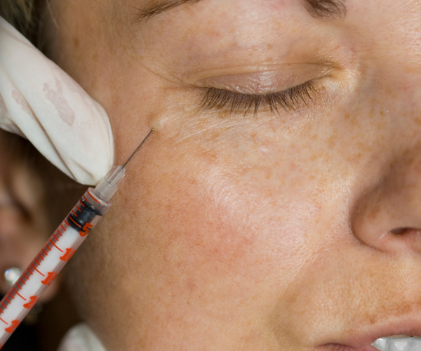 botox twarz (1) botox twarz (1)